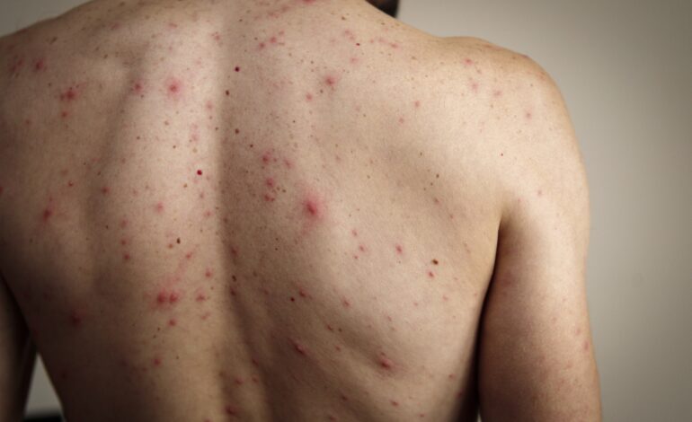 En Carolina del Sur se produce un brote de sarampión. Departamento de Salud Pública en alerta